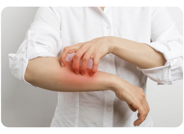 Objawy nietolerancji histaminy a dieta pudełkowa – jak catering dietetyczny może pomóc złagodzić zmiany skórne