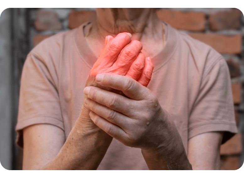 Zaczerwieniony i obolały duży palec u stopy jako objaw dny moczanowej, dieta niskopurynowa w cateringu dietetycznym